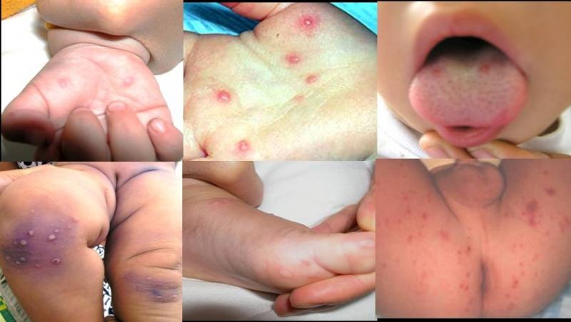 Những vị trí thường xuất hiện nổi ban đỏ trên da