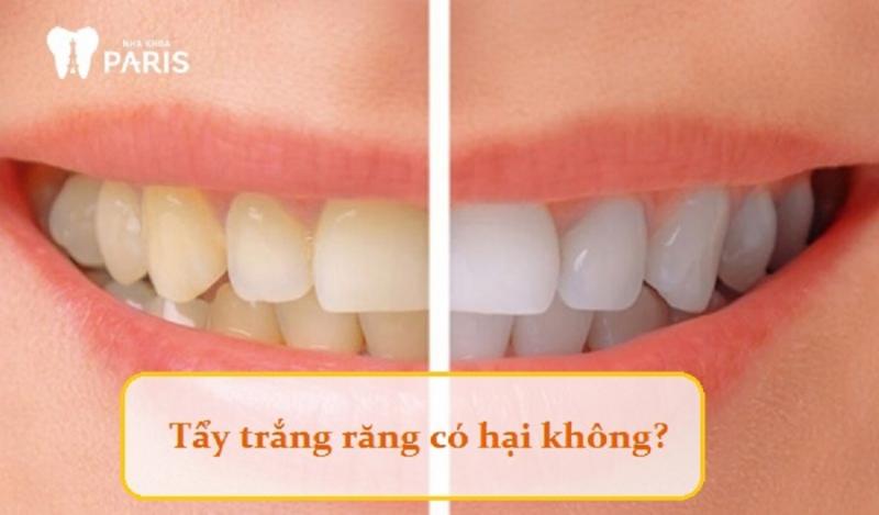 Tẩy trắng răng có hại không?