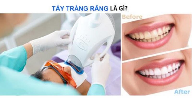 Tẩy trắng răng là gì?