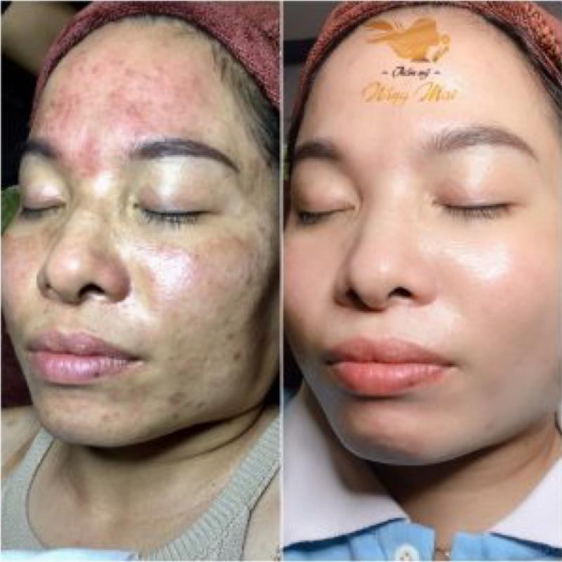 Chăm sóc điều trị da nám sau 3 tuần tại Thẩm Mỹ Nắng Mai
