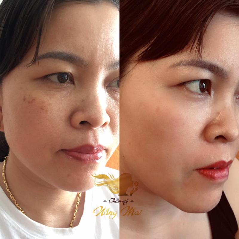 Điều trị nám da sau 3 tuần tại Thẩm mỹ Nắng Mai