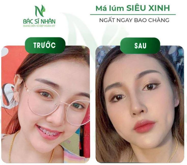 Tạo má lúm tại Thẩm mỹ viện Bác Sĩ Nhân