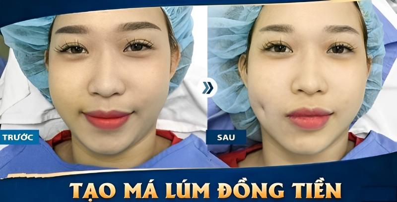 Tạo má lúm tại Thẩm mỹ viện DIVA