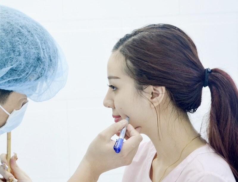 Tạo má lúm tại Thẩm mỹ viện DIVA
