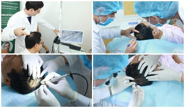 Quy trình cấy tóc tại TMV Đông Á