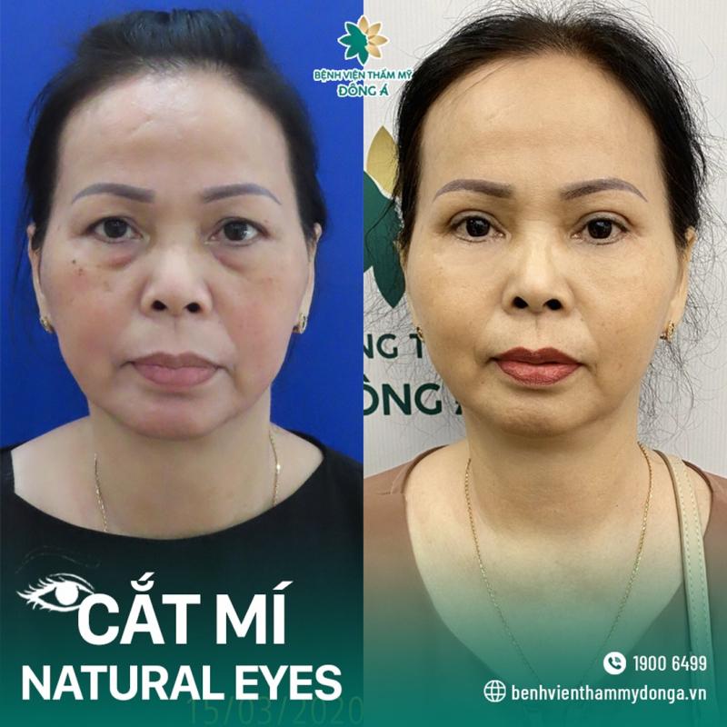 cắt mí tại Thẩm mỹ viện Đông Á