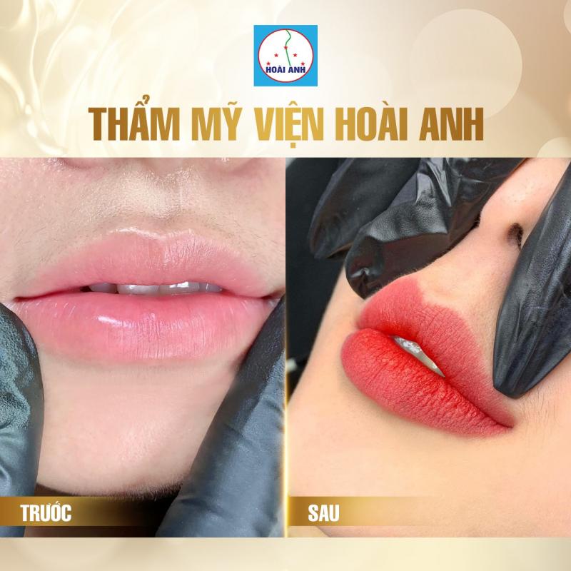 Thẩm mỹ viện Hoài Anh