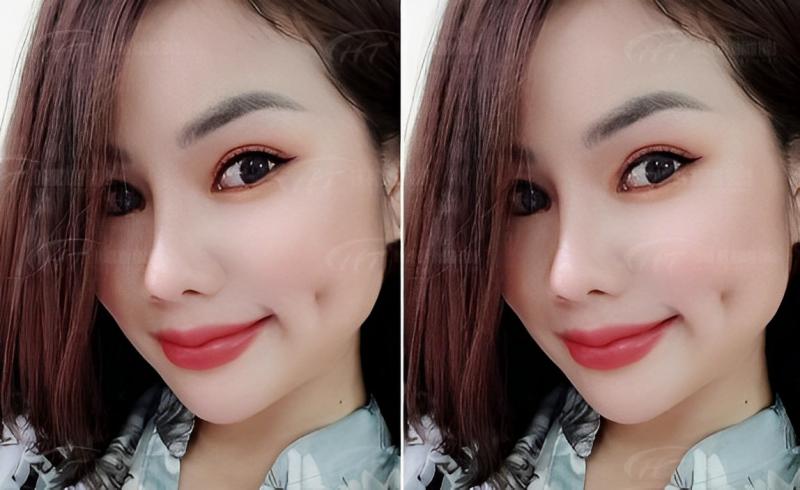 Tạo má lúm tại  thẩm mỹ viện Linh Châu
