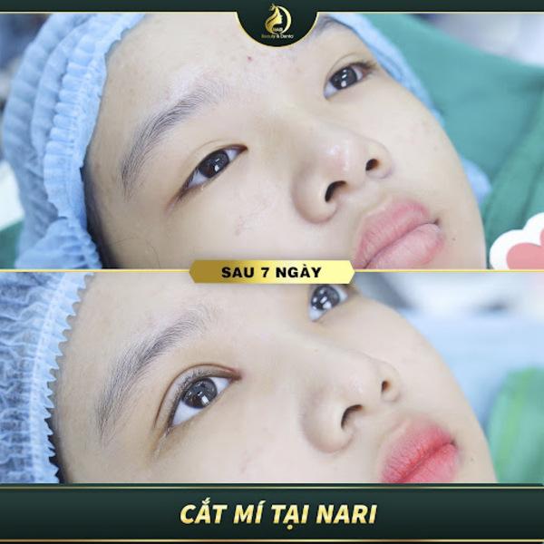 Cắt mí tại Nari với nhiều đặc điểm nổi bật