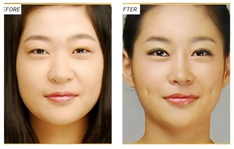 Khách hàng tạo má lúm đẹp tại Thẩm mỹ viện Ngọc Dung