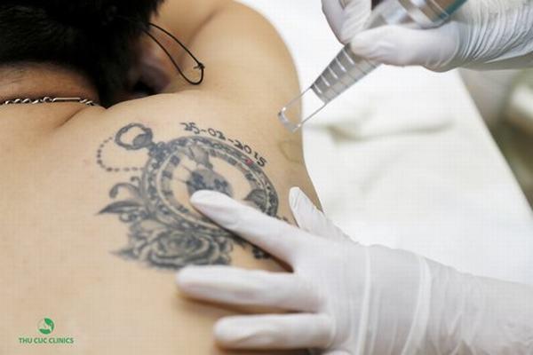 Khách hàng trải nghiệm dịch vụ xóa xăm tại Thẩm mỹ viện Thu Cúc