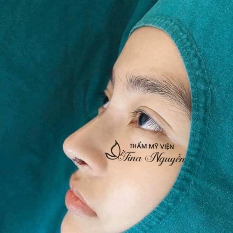 Thẩm Mỹ Viện Tina Nguyễn