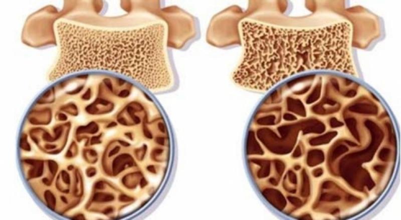 Cần thận với các loại thuốc có thể gây loãng xương