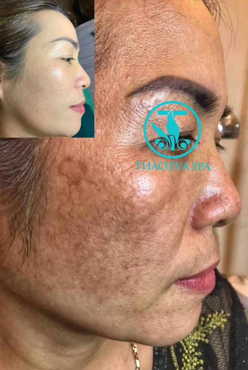 Hiệu quả điều trị nám tại Thảo Eva