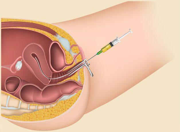 Thế nào là phương pháp thụ tinh nhân tạo
