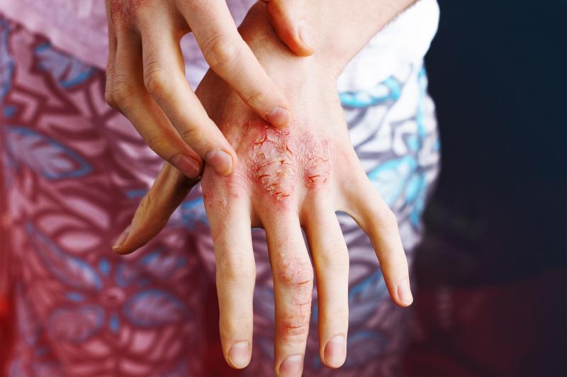 Thiếu vitamin D