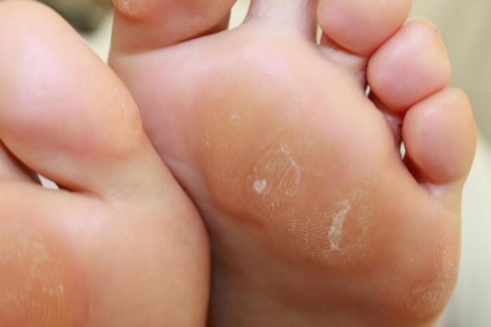 Thường xuyên sử dụng dép xỏ ngón, giày boots không tốt cho đôi chân của bạn