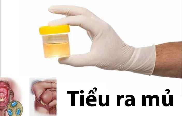 Tiểu ra máu, tiểu mủ