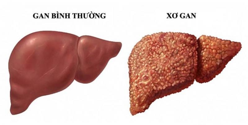 Tổn thương gan
