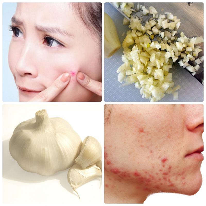 Tỏi vốn là nguyên liệu thiên nhiên trị mụn ẩn dưới da rất hiệu quả.