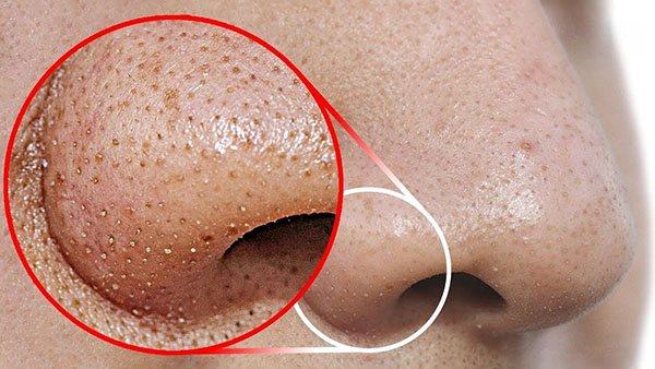 Aspirin kết hợp cùng với mật ong và sữa chua sẽ là phương pháp an toàn cho bạn trong việc loại bỏ mụn đầu đen.