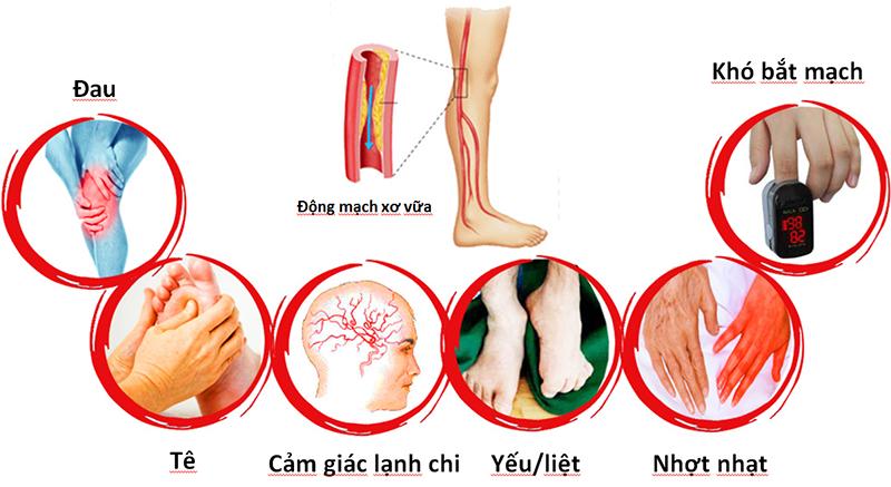 Triệu chứng của bệnh động mạch ngoại biên
