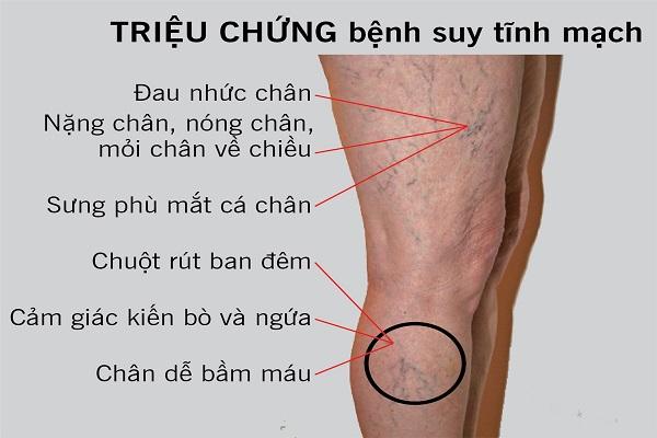 Triệu chứng suy giãn tĩnh mạch
