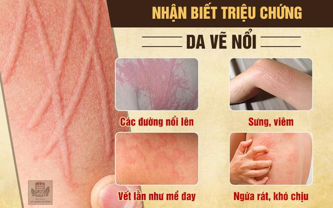 Triệu chứng da vẽ nổi