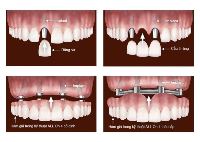 Các dạng phục hình trên Implant