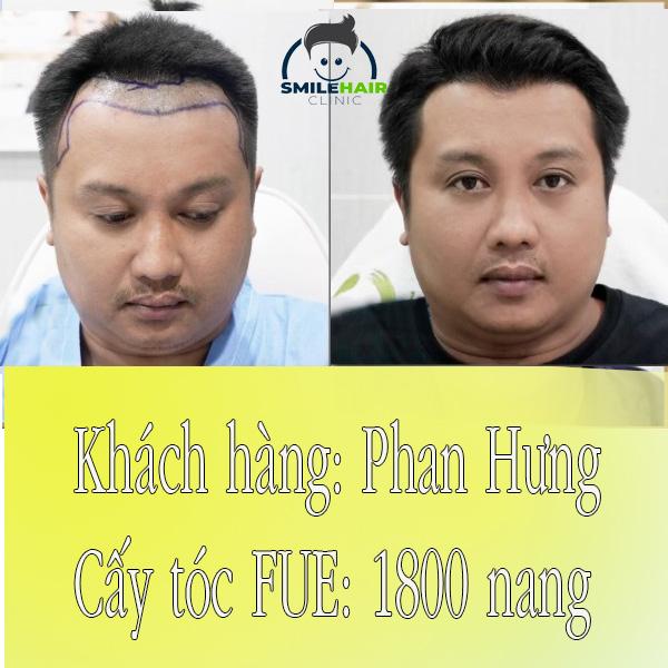 Trung tâm cấy tóc tự thân Smile Hair