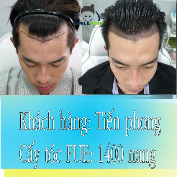 Trung tâm cấy tóc tự thân Smile Hair