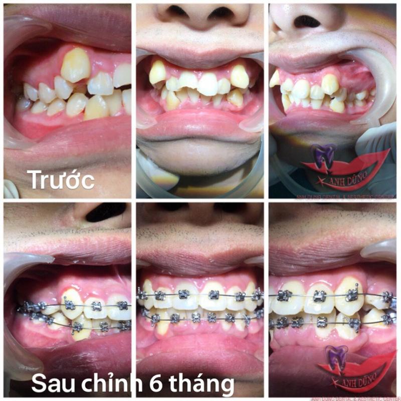 Trước và sau chỉnh nha tại Trung tâm Nha Khoa và thẩm mỹ Anh Dũng.