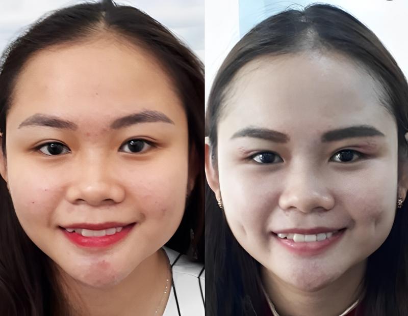 Tạo má lúm tại Khoa Phẫu thuật tạo hình thẩm mỹ - Đại học Đà Nẵng