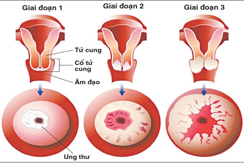 Bệnh ung thư cổ tử cung thường gặp ở độ tuổi từ 30-59