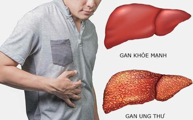 Ung thư gan