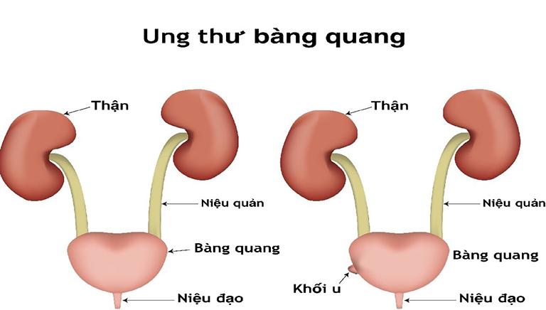 Ung thư bàng quang do hút thuốc lá