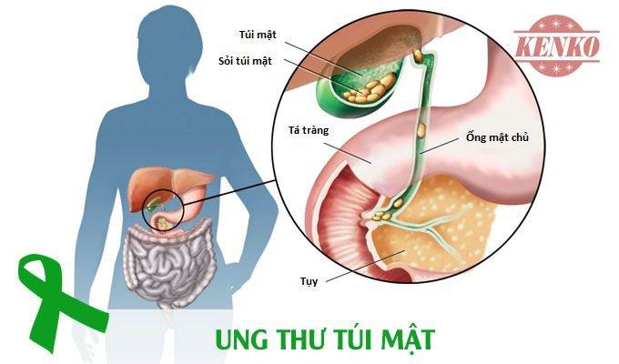 Ung thư túi mật