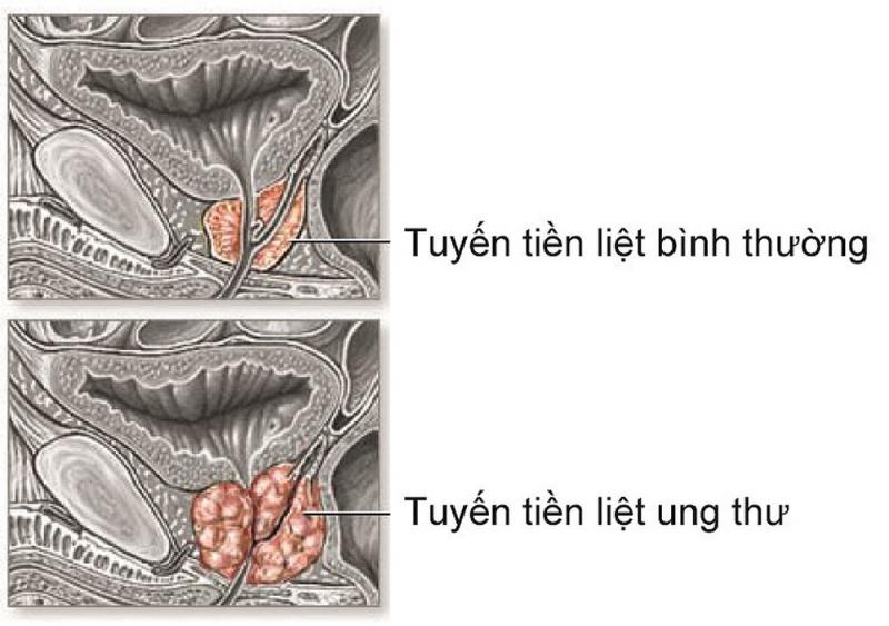 Ung thư tuyến tiền liệt