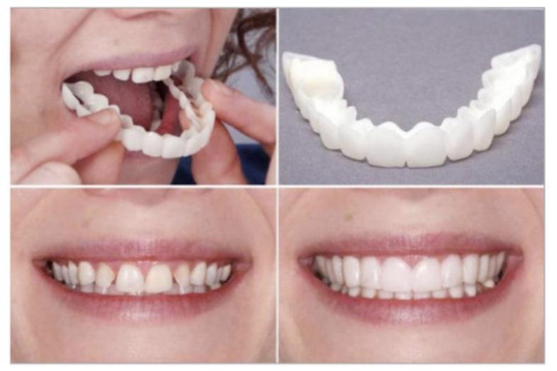 Ưu điểm của răng giả tháo lắp