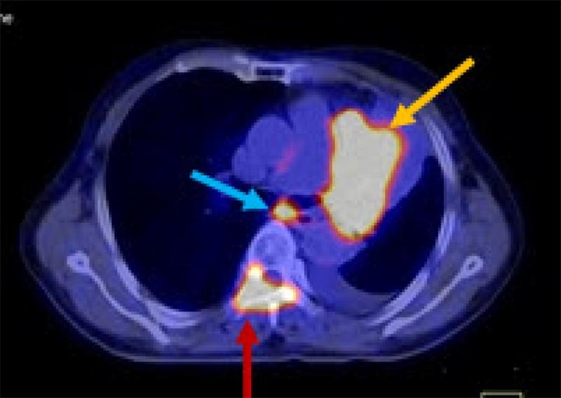 Vai trò của PET/CT trong ung thư