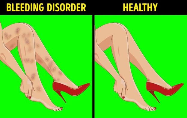 Vết bầm tím không rõ nguyên nhân trên chân