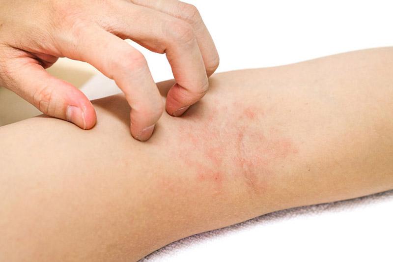Viêm da là căn bệnh dễ mắc trong mùa hè