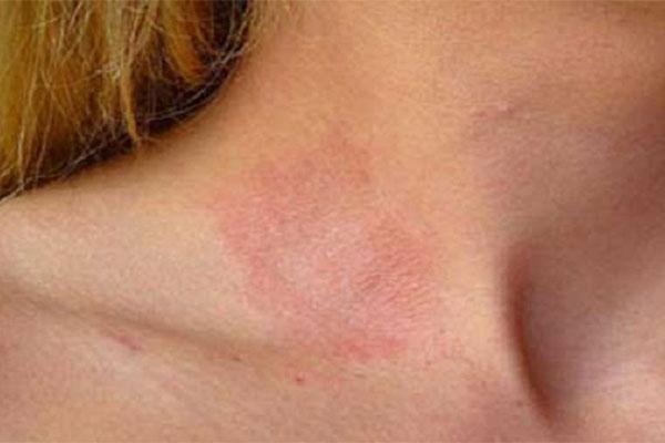 Ăn nhiều đường có thể gây viêm da