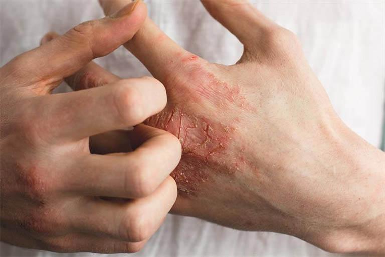 Viêm da cơ địa có nguy hiểm không?