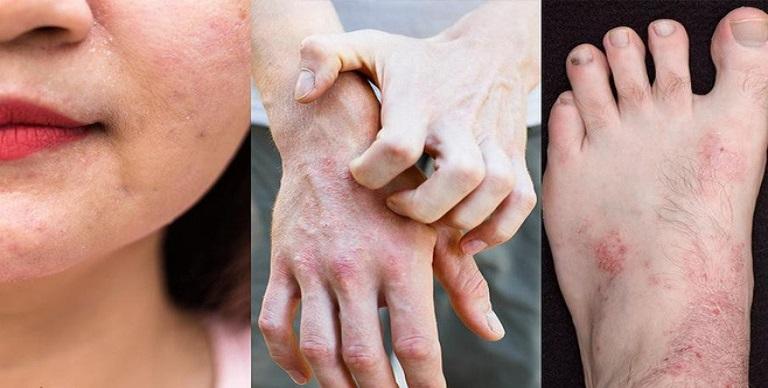 Viêm da cơ địa là bệnh gì?