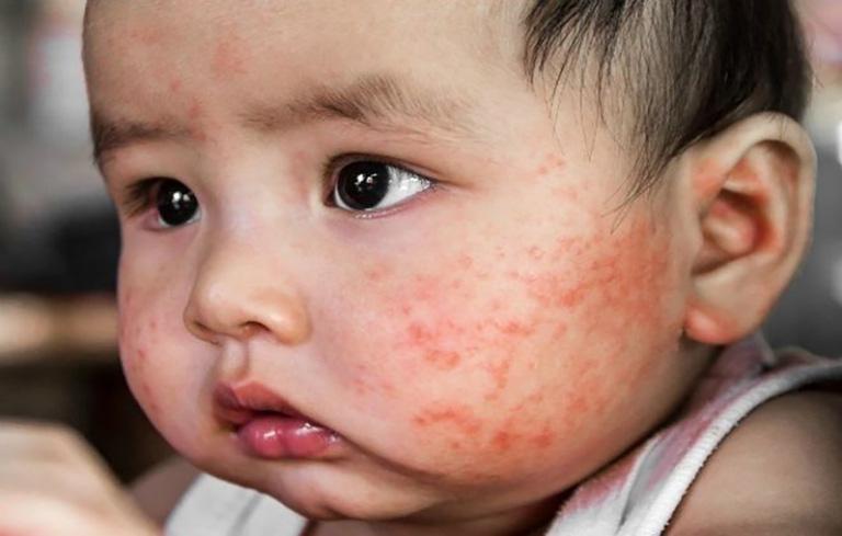 Khi bị côn trùng đốt, da sẽ đỏ, sưng phù và ngứa nhiều