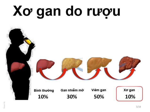 Viêm gan, xơ gan do rượu
