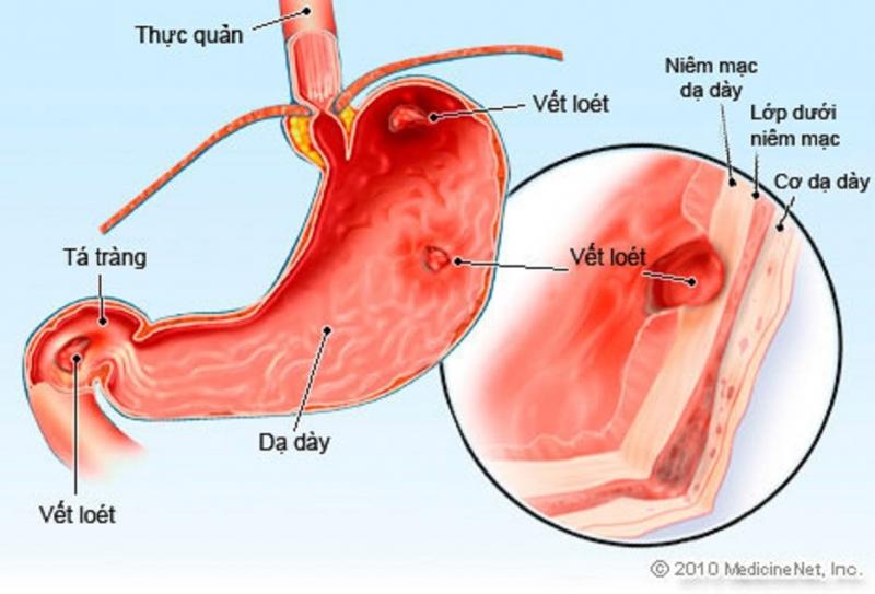 Bệnh viêm loét dạ dày