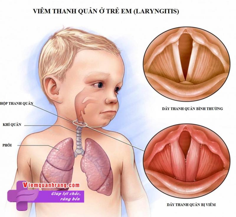 Viêm thanh quản gây ra ho, ho khan, khàn tiếng