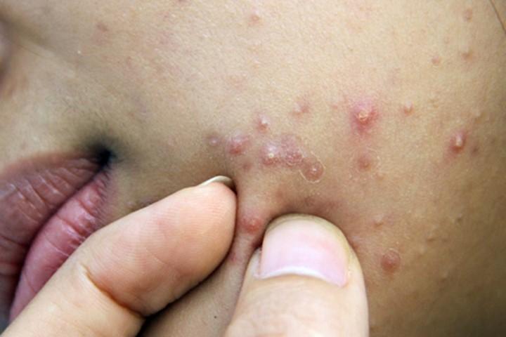 Viêm tuyến mồ hôi thường xuất hiện sâu trong da xung quanh các tuyến dầu và các nang tóc